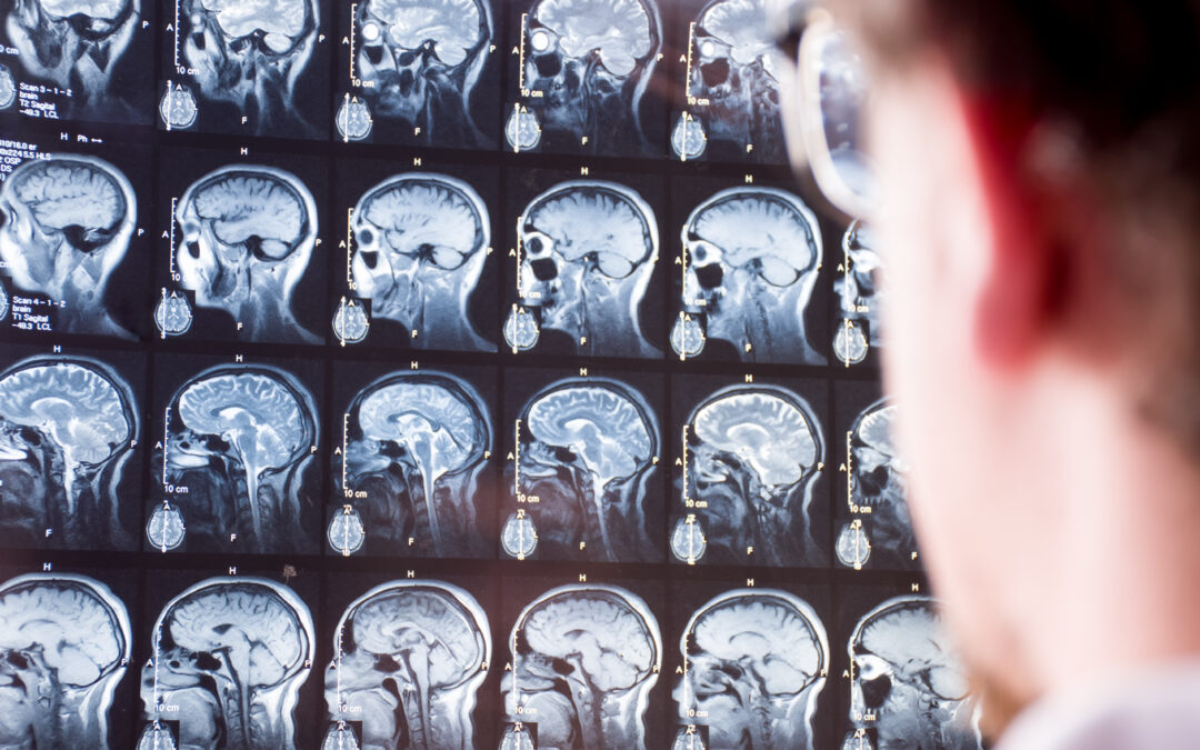 MRI scan of head and brain. Doctor in foreground with blurred silhouette looks at magnetic resonance imaging of brain of patient in background in focus. Concept image in neurology or neurosurgery