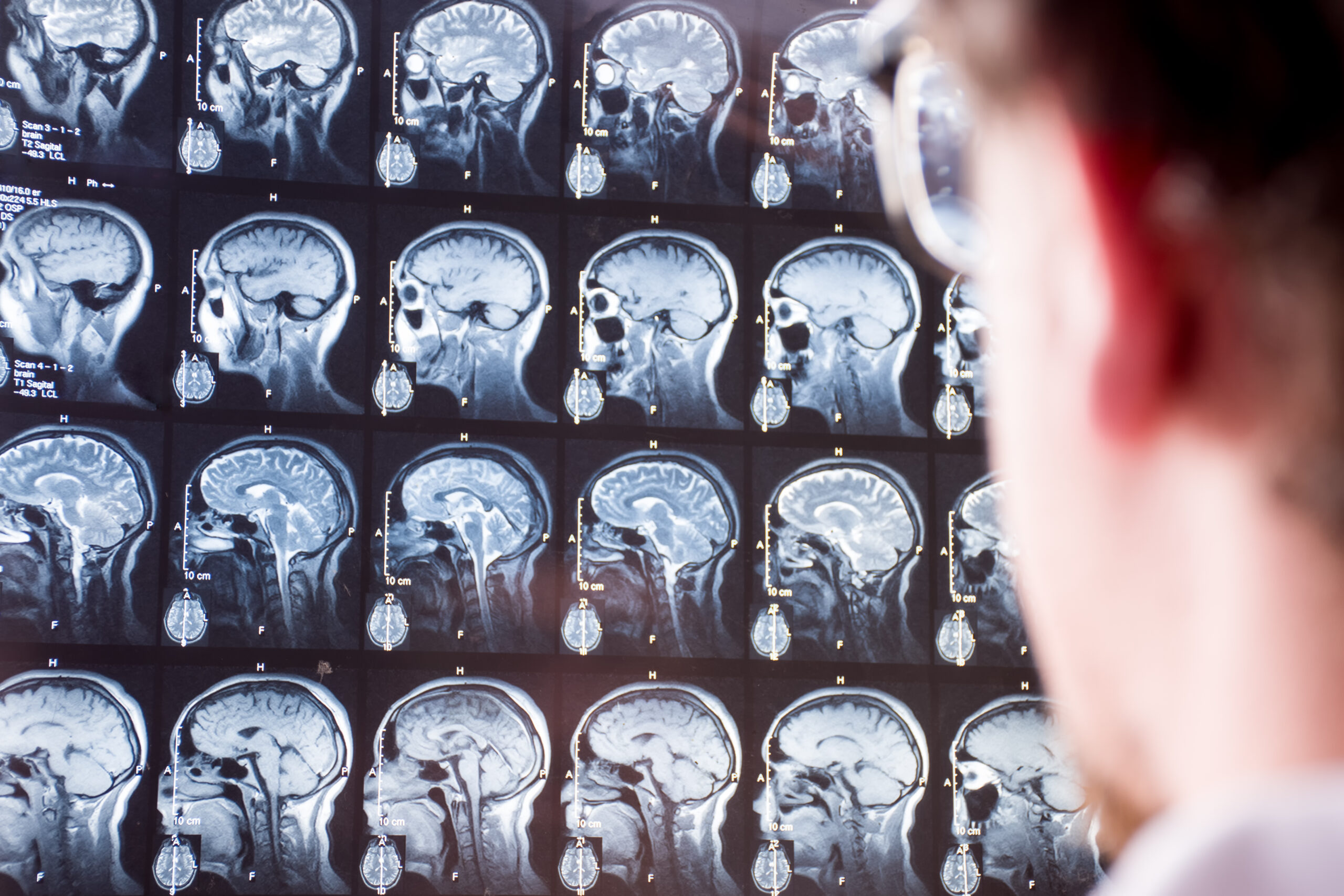 MRI scan of head and brain. Doctor in foreground with blurred silhouette looks at magnetic resonance imaging of brain of patient in background in focus. Concept image in neurology or neurosurgery